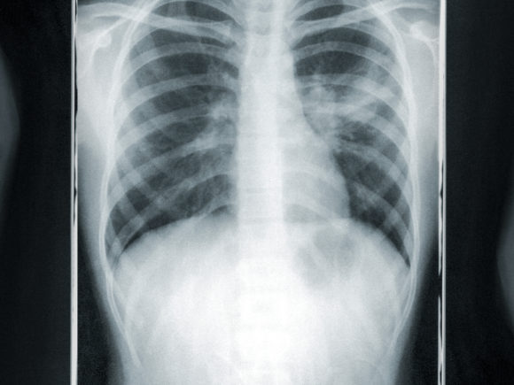 Photograph of a chest x-ray