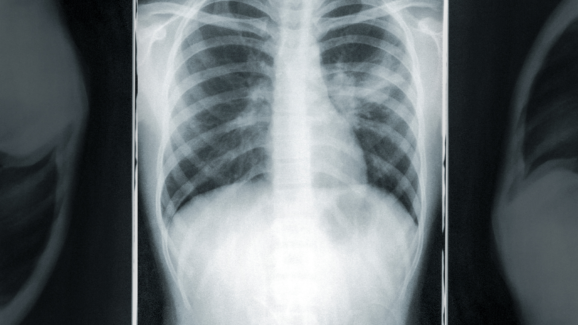 Photograph of a chest x-ray