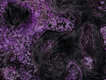 Photograph of lung cancer cells driven by the KRAS oncogene which is highlighted in purple