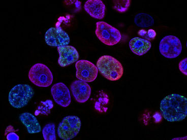 Close-up photograph of cancer cells that are highlights in blue, pink, purple, and green circular shapes